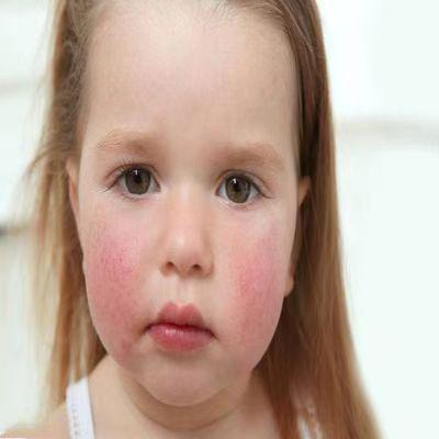 孩子身上若这三处出现红血丝家长别不当回事赶紧带去医院